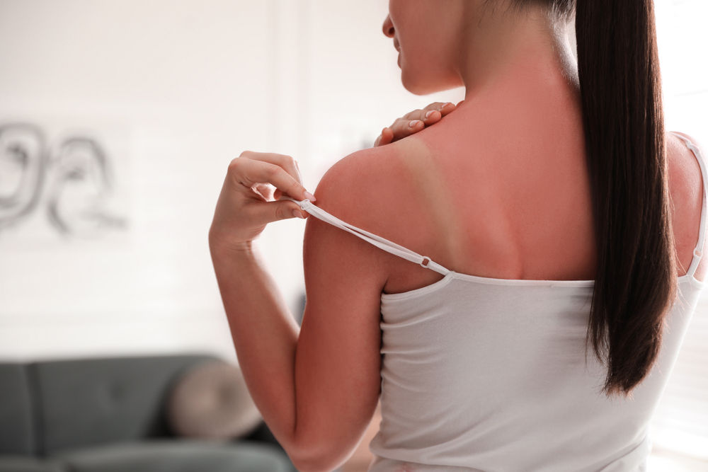 Perchè ci scottiamo al sole?
