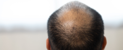 Perché gli uomini perdono i capelli?